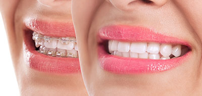 Dental Braces 20783