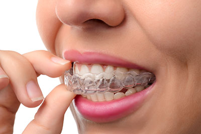 Hyattsville Invisalign