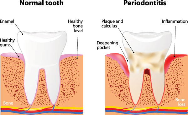 Hyattsville Periodontal Treatment