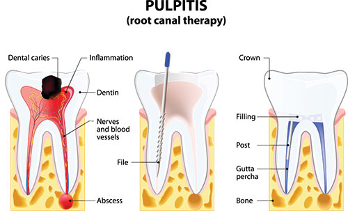 Root Canal Treatment in Hyattsville