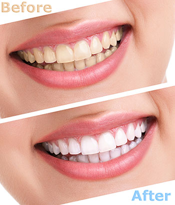 Hyattsville Teeth Whitening