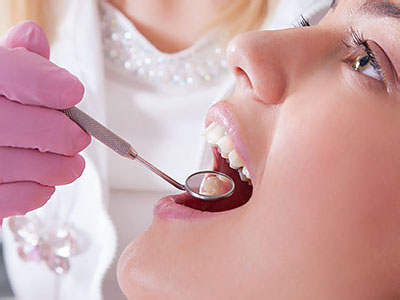 Hyattsville Dental Fillings